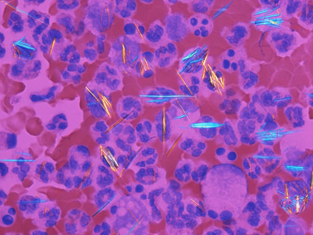 gout_-_monosodium_urate_crystals_20x_polarized_red_compensator