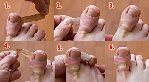 Ingrown_toenail_treatment
