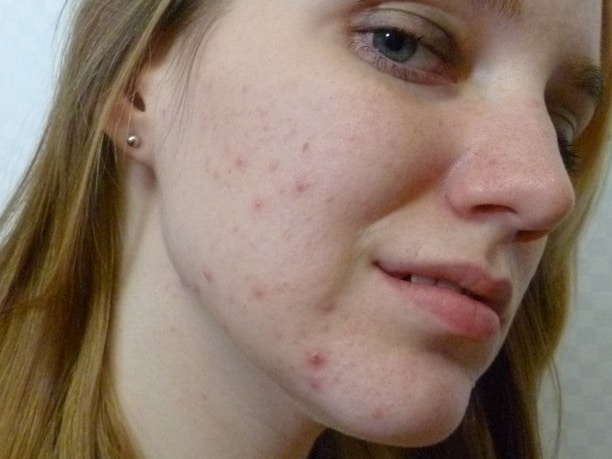 acne-girl