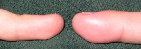 myparonychia