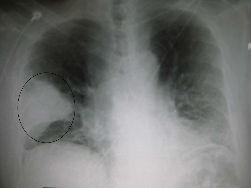 pneumoniswedge09