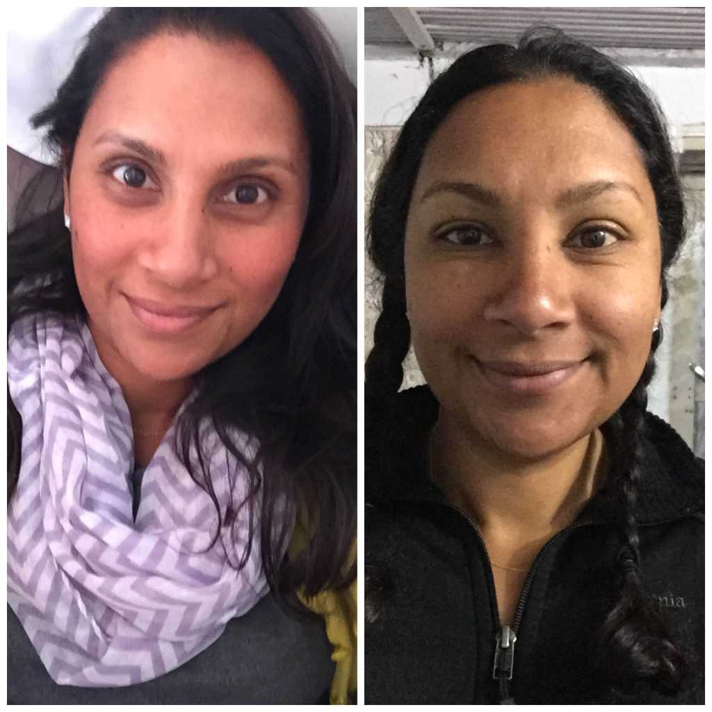 peripheral_edema_of_a_womans_face_before_and_after_annapurna_base_camp_2015