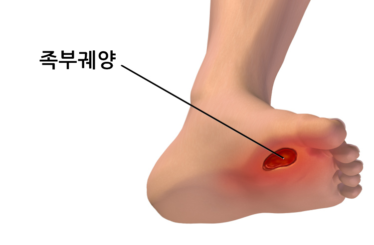 족부궤양