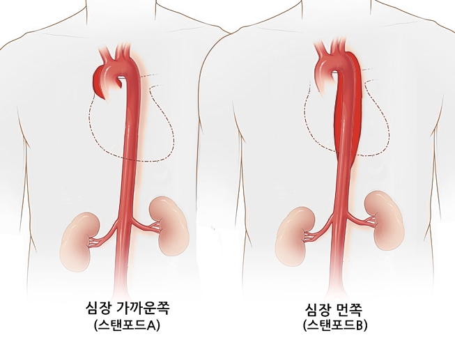 대동맥박리