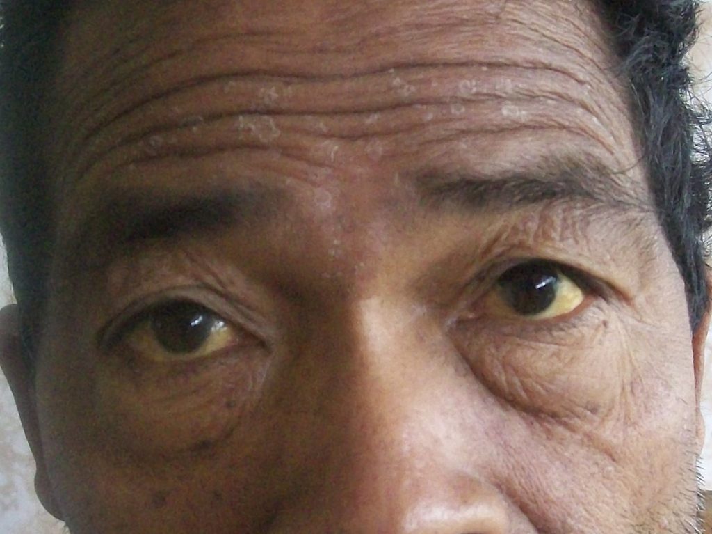 황달