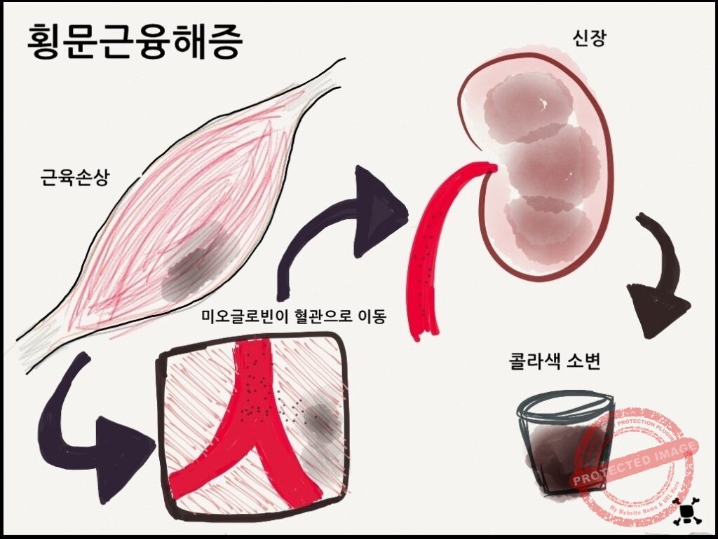횡문근융해증
