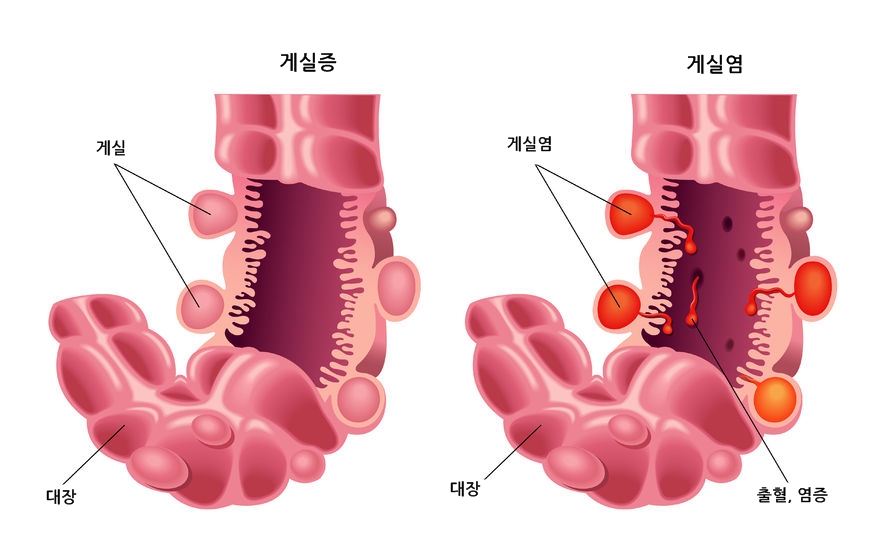 게실증과 게실염