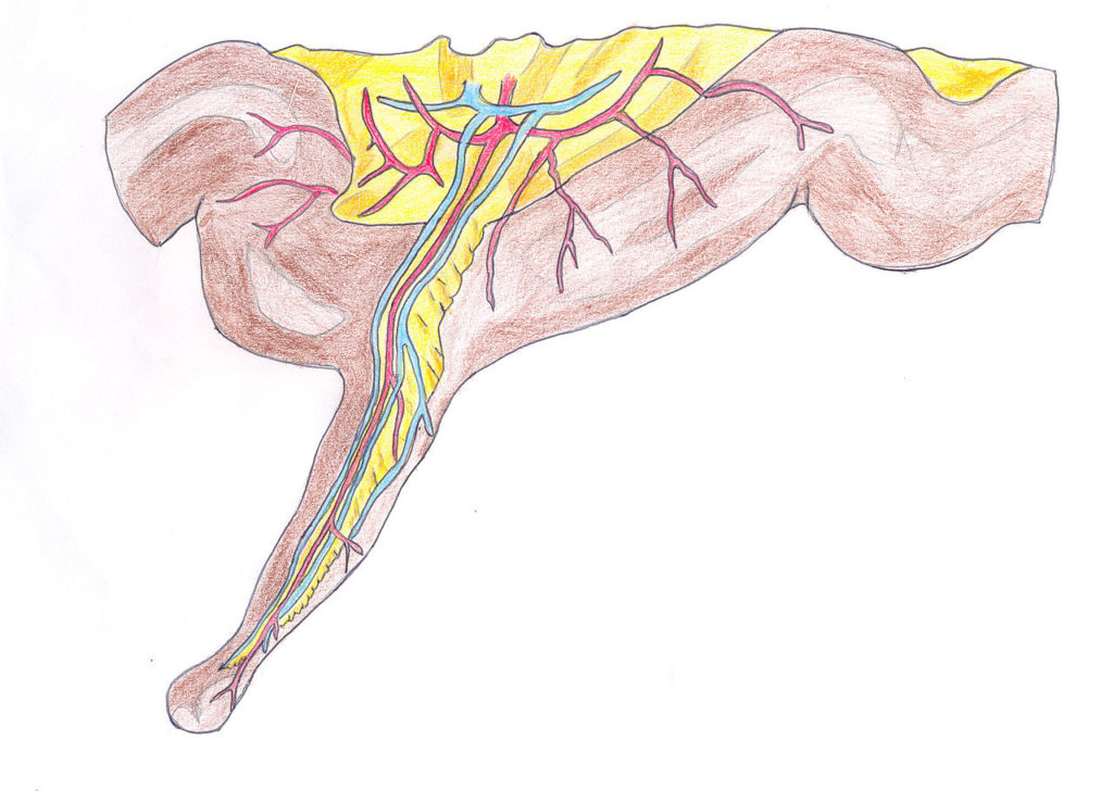1280px-Diverticule_de_Meckel
