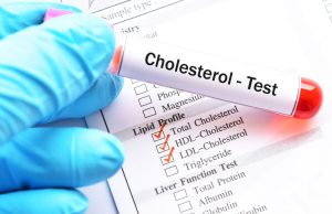 콜레스테롤 혈액검사